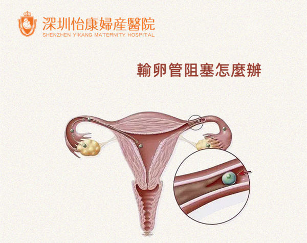 女性不孕不育檢查 輸卵管造影價錢
